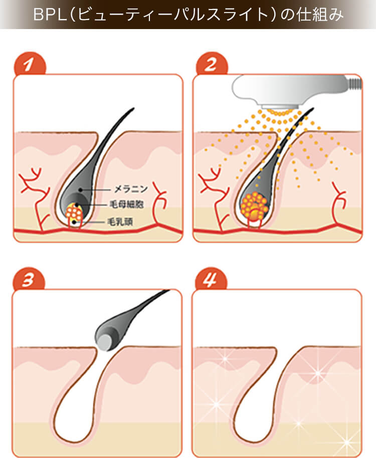 BPL（ビューティーパルスライト）の仕組み