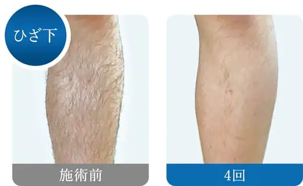 ひざ下 施術前 4回