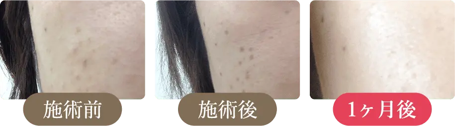 施術前→施術後→1ヶ月後