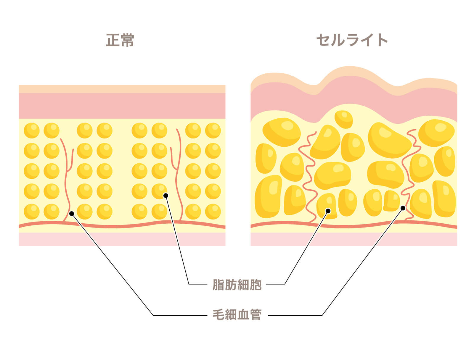 セルライト