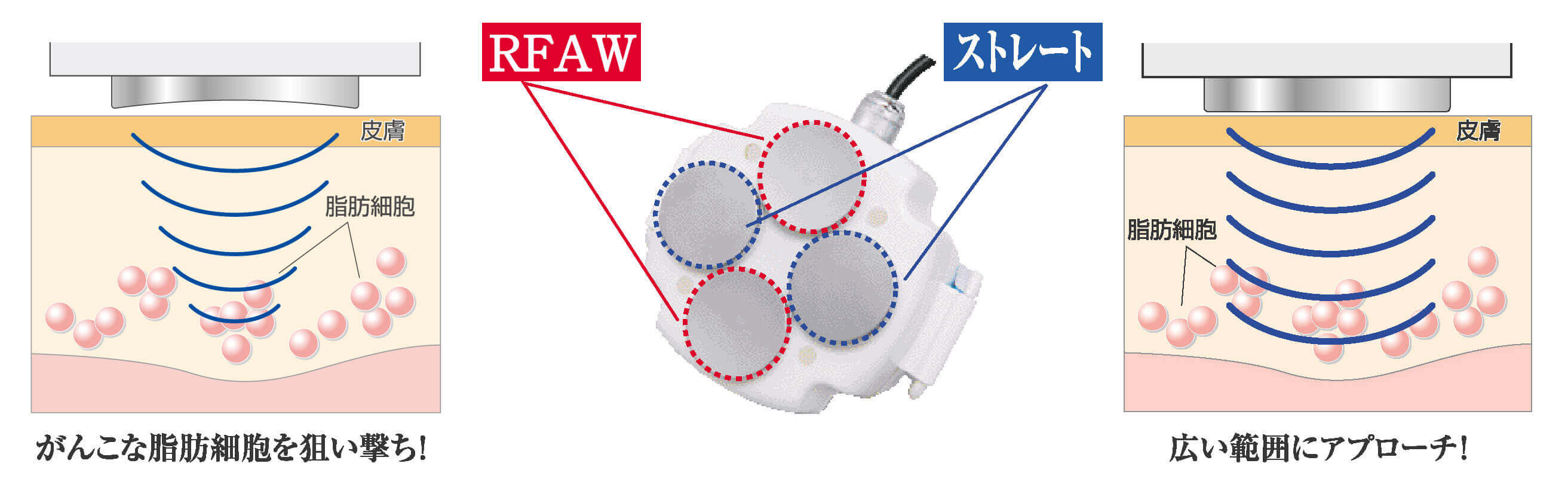 キャビテーション（RFAW）