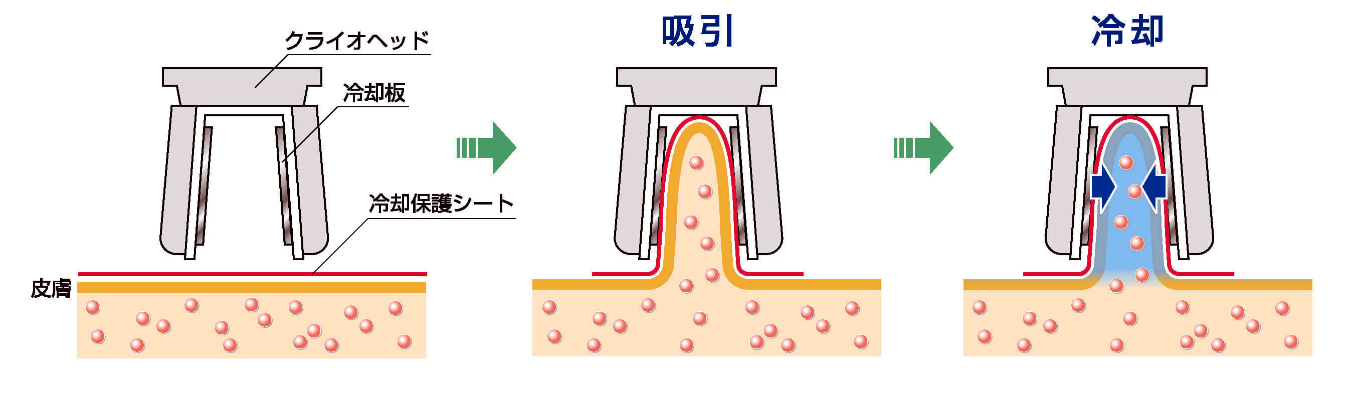 クライオ（吸引冷却）