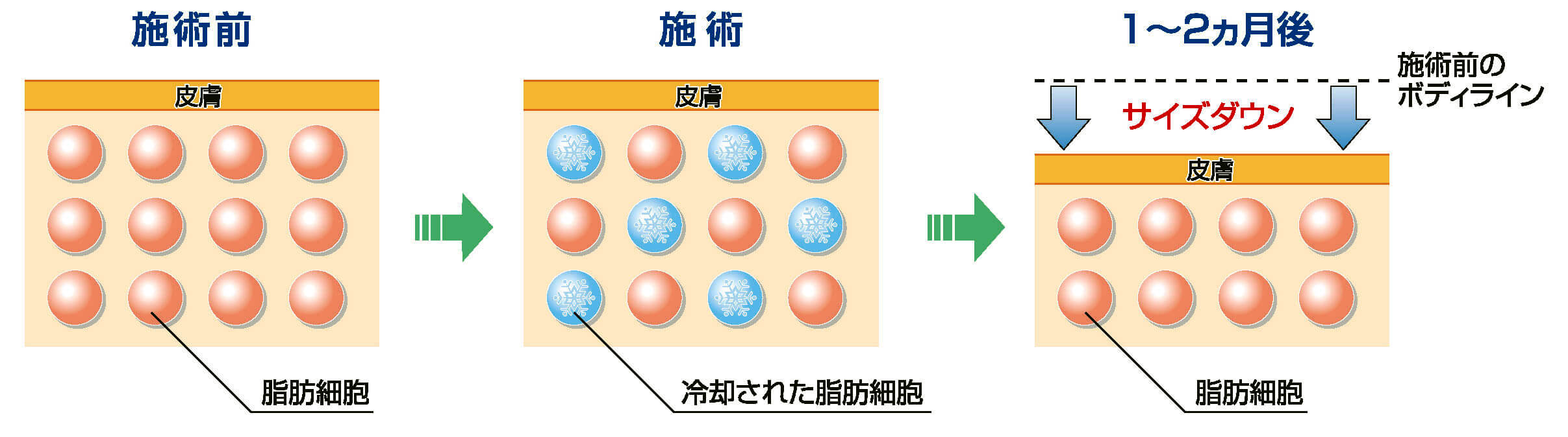 クライオリポライシス理論