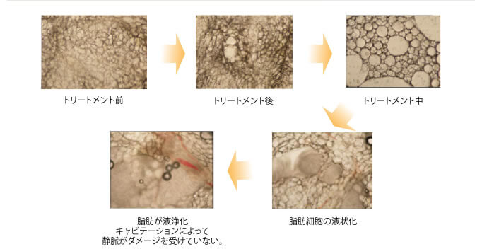 キャビテーションによる脂肪細胞の変化