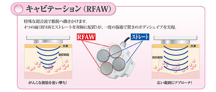 キャビテーション