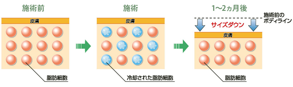 冷却痩身技術の原理