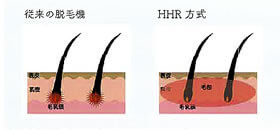 HHR（Hybrid Hair Removal）方式採用