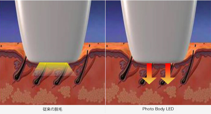 業務用脱毛機・脱毛器  からへ進化 – 美容