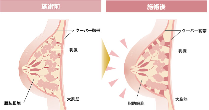 バスト 施術前　施術後