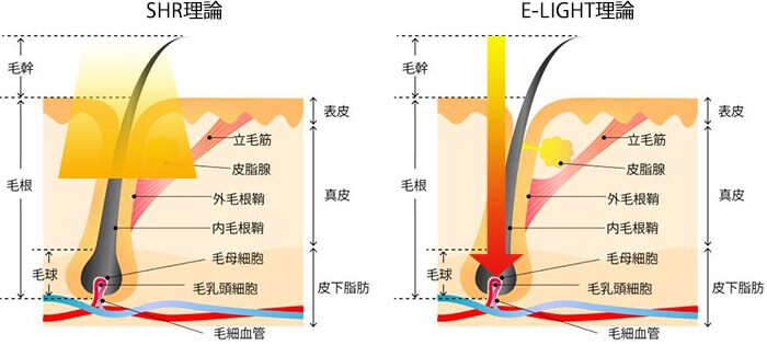 SHRとE-LIGHTの脱毛理論