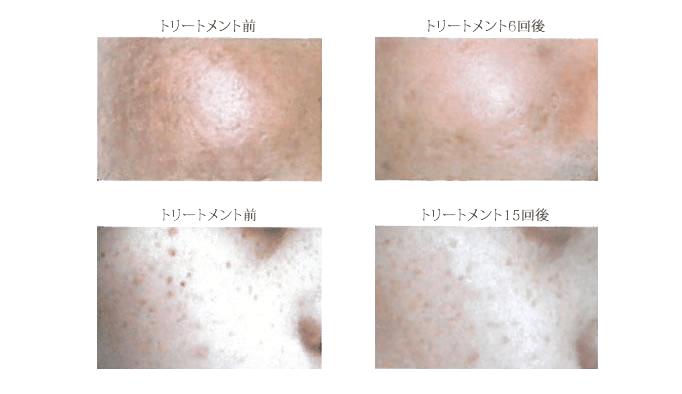 ESSENTIAL peel～エッセンシャルピール～症例